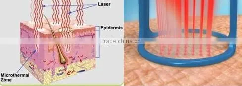 Medical CE FDA Approved Fractional co2 laser for facial resurfacing and ance scars