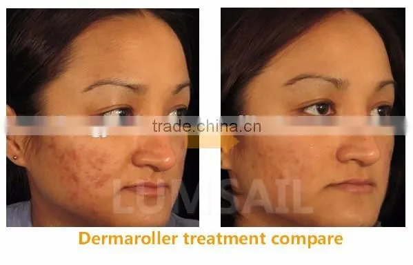 540needles Dermaroller /Derma Skin Roller /Microneedles Dermaroller