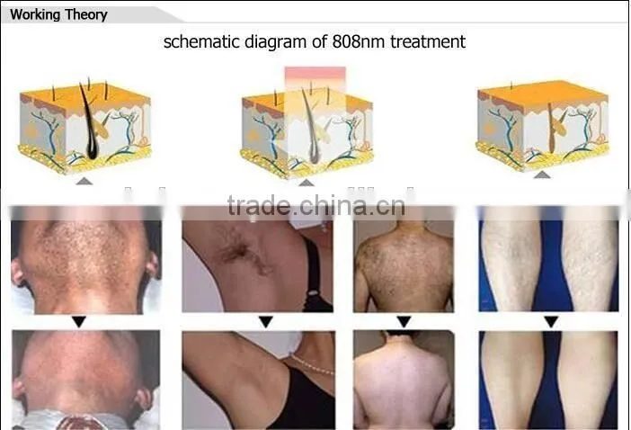 High Quality Portable Permanent Hair Removal With CE Approved