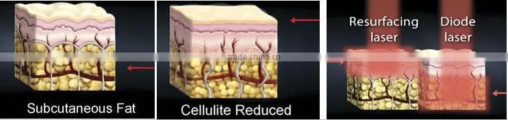 3in1 cavitation laser radio frequency for slimming