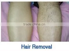 2015 Newest multifunctional cosmetic equipment ipl hair removal germany skin solution