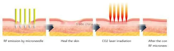 Top performance!!!! microneedle skin treatment portable fractional rf