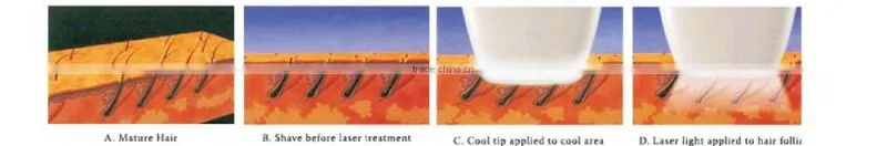 Painless no side-effect diode hair removal laser machine