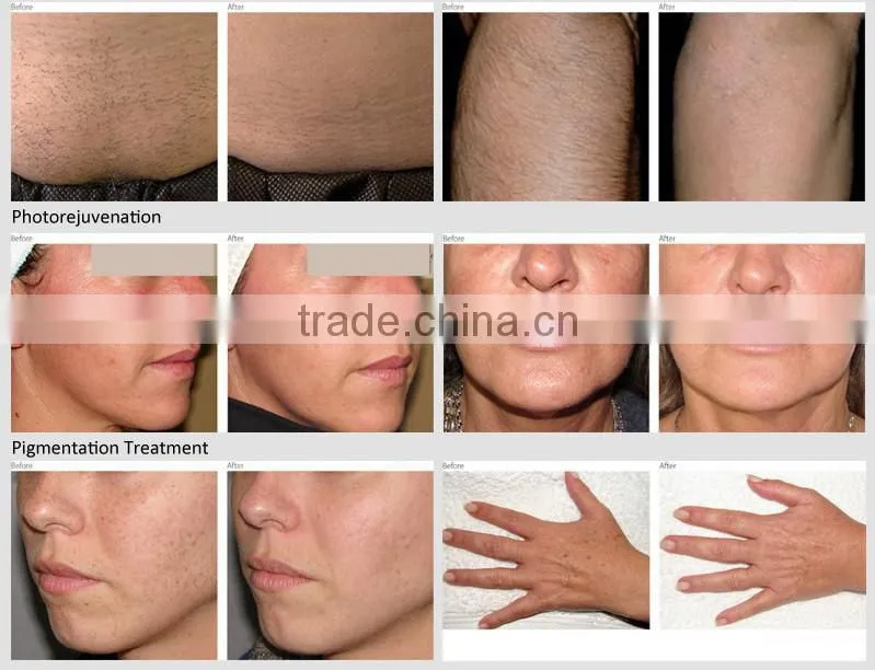 LINGMEI promotion home laser hair removal