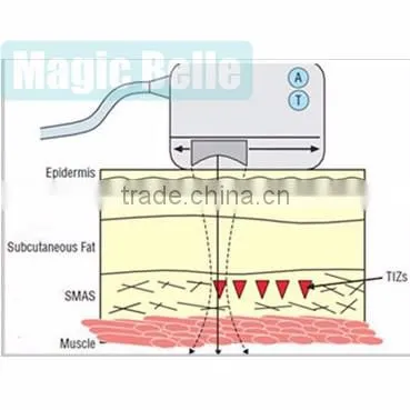 4 tips HIFU Machine Removal Double Chins Professional Clinic HIFU Machine with Teaching Video