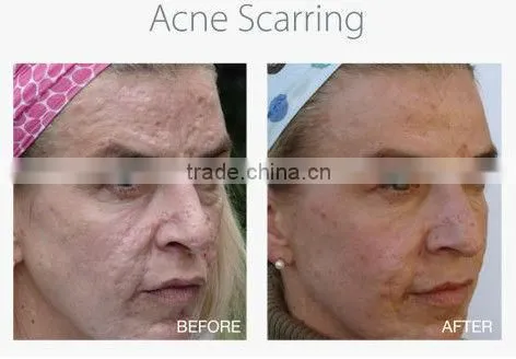 Body / skin regeneration MT Dermaroller Treatments