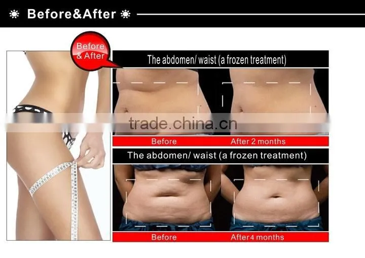 Portable cryolipolysis fat freezing device