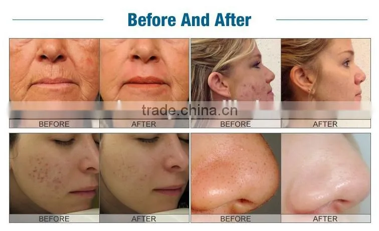 oxigeno facial machine/ultrasonic facial machine/aparatos faciales M-H701