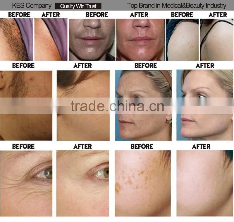 Ipl multifunction beauty machine salon for hair removal&skin rejuvenation and pigmentation removal