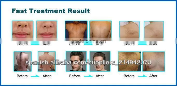 promotion multi system 2015 best e light ipl rf system(CE ISO TUV BV)