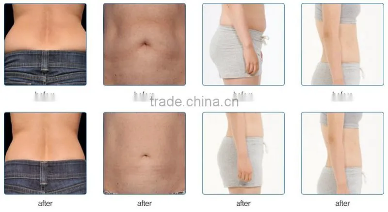 2015 hot new cryolipolysie Fat Freezing slimming machine with 3 heads best cryolipolysie fat freezing