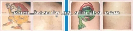 New Year Surprising Gift Laser machine with Q-switch yag for tattoo and eyebrow removal