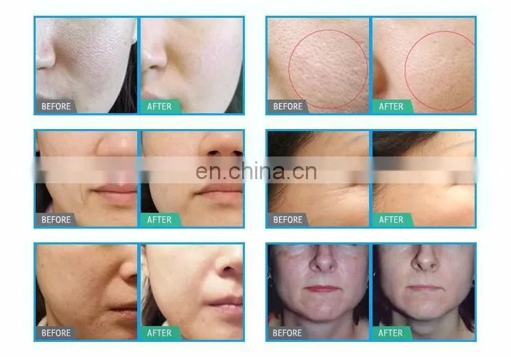 portable home use hydra beauty peel facial dermabrasion machine