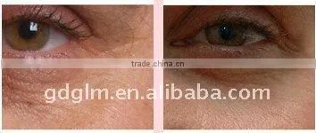 E-light permanent hair removal instrument E-009
