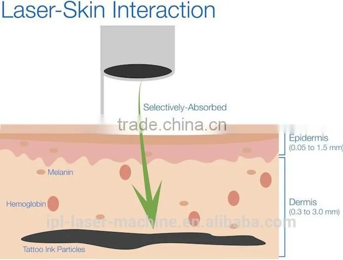 Best nd yag laser tattoo removal with good quality