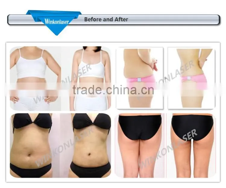 weight loss supplement/HIFU Slimming/HIFU weight loss