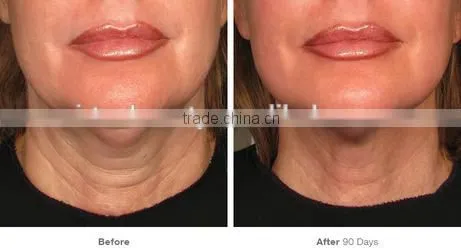 Newest Technology Hifu , Hifu Face Lift , Hifu Machine