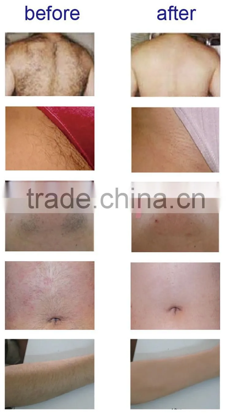 Hi-tech laser depilacion /depilacion system best 808 diode hair removal treatment laser /maquinas de depilacion laser diodo