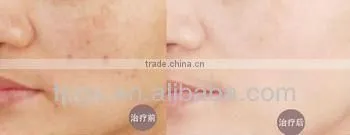 2013 newest Mini ipl hair removal and Skin rejuvenation beauty machine
