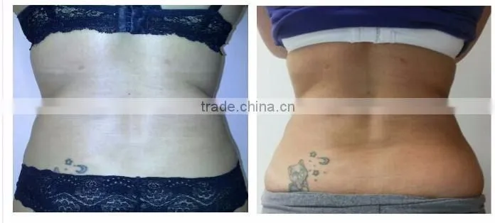 Spa use machine for body scupture fat removal slimming cryolipolise