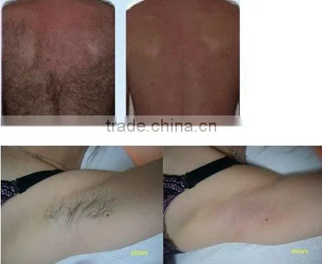 Most popular electric permanent hair removal 1064nm - P003