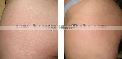 Clinic derma roller systerm for acne and wrinkle removal L008