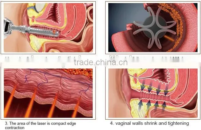 Hot sale scar removal skin tighten Fractional Laser Co2 / CO2 fractional laser/ fractional co2 laser machine