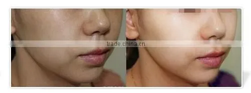 Professional Injection Meso Mesotherapy Gun For Skin Whitening Wrinkle Removal