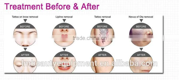 2015 portable acne scar removal for laser beauty machine