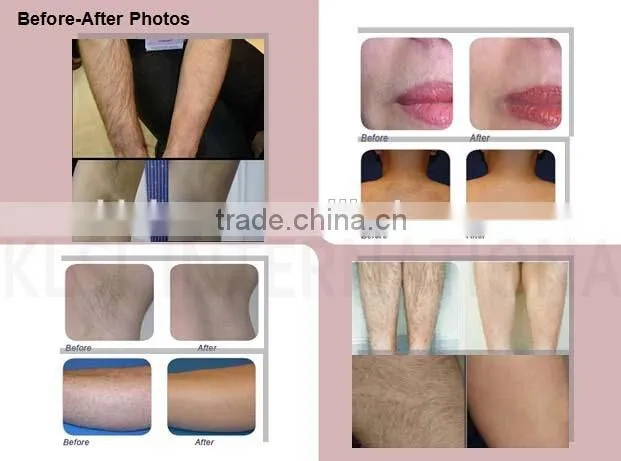 KLSi Top Quality 808nm Diode Laser Permanent Hair Removal