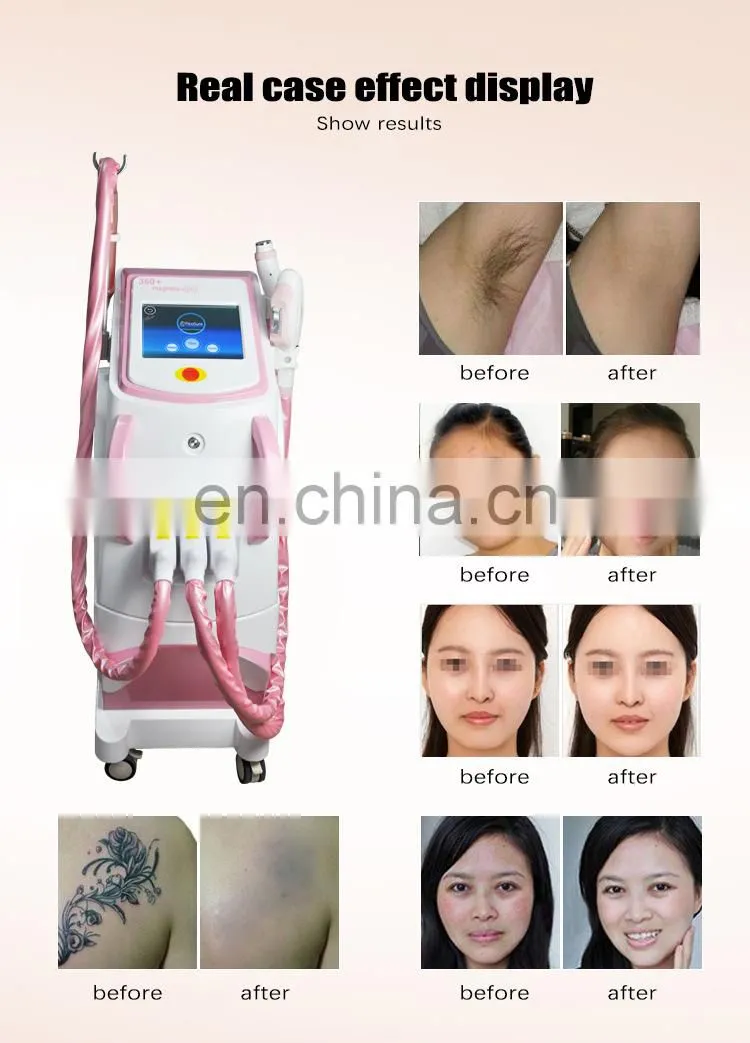 multifunctional 4 in 1 e-light ipl rf yag laser machine for sale