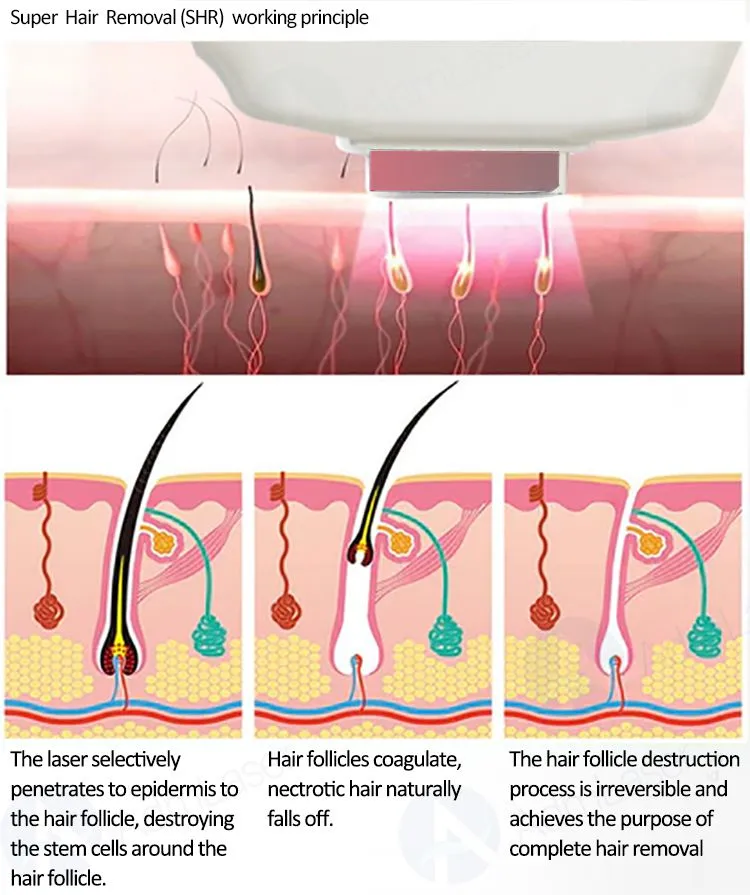 Portable DPL Optical Skin Beautification Skin Rejuvenation BBL Pigmentation 480nm Dpl Freckles Age Spots Removal