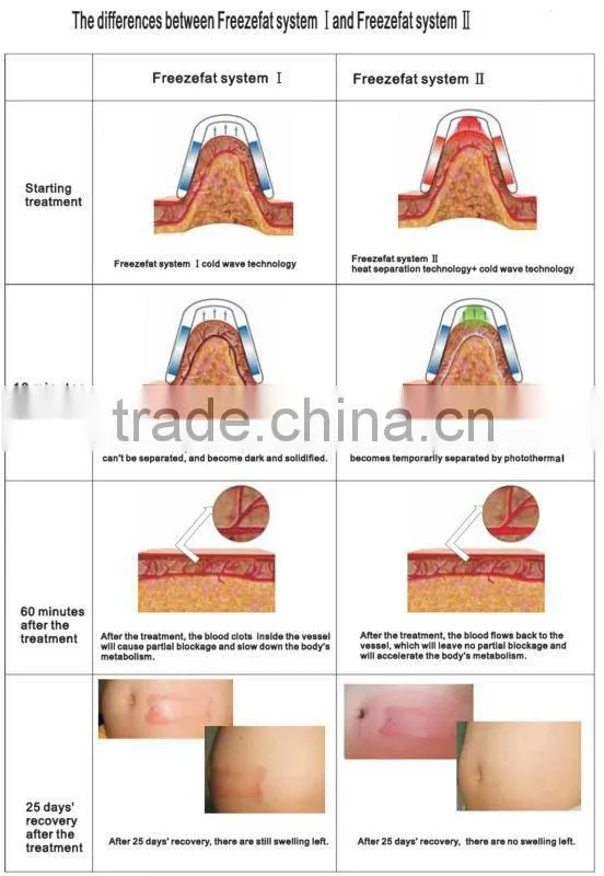 2016 Hot Selling!!! criolipolise device/criolipolise antifreeze membrane