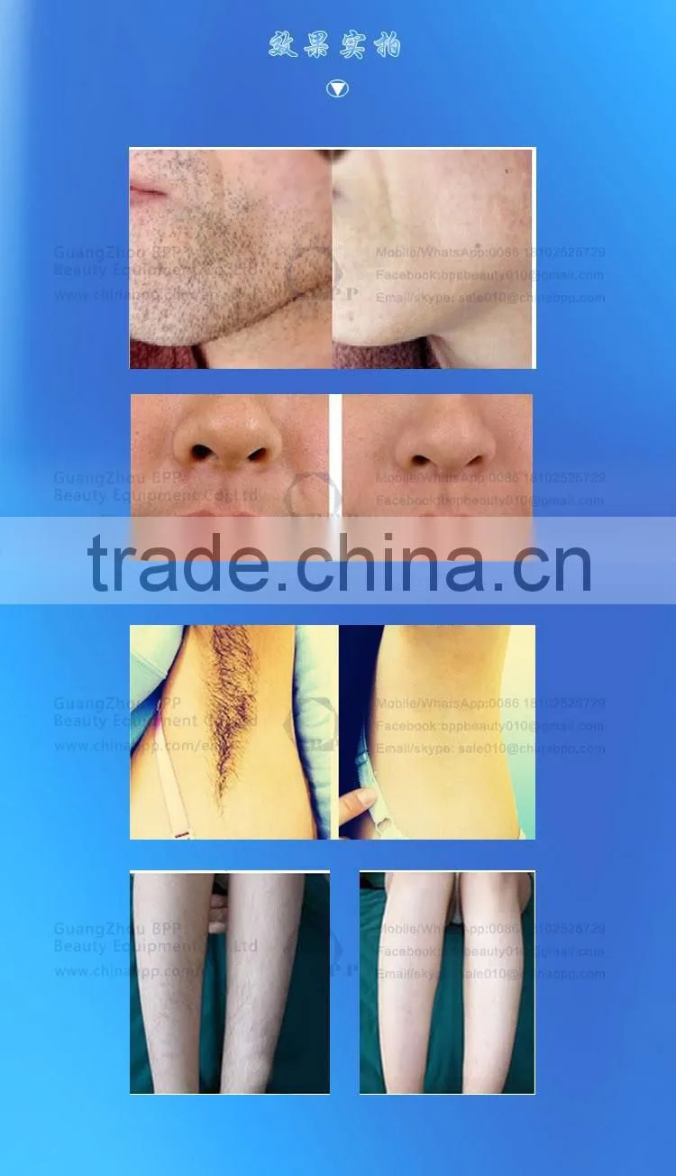 The most effective handheld laser hair removal beauty machine