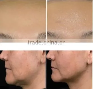 Micro needle RF fractional beauty spa machine for scar removal stretch marks removal