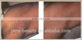 hot distribution professional 2000 w beauty equipment hair removal ipl shr laser