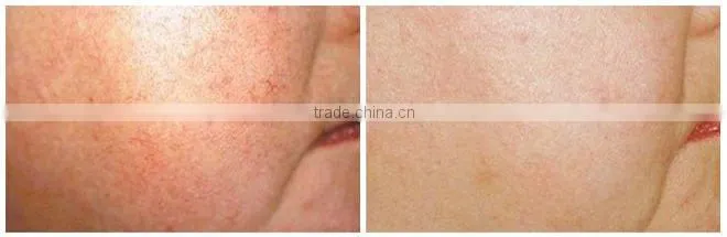 Professional IPL facial hair removal
