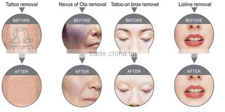 q switched laser nd yag laser facial moles tattoo removal yag machine