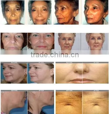 rf skin firming machine