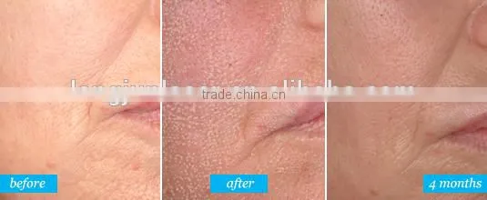 Fractional co2 laser skin resurfacing and stretch mark removal machine