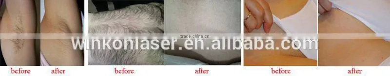 Long pulse nd yag 1064 nm hair removal laser for kinds of color