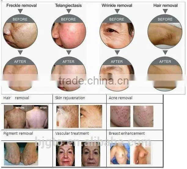 2014 Hot sale Vertical E-light(IPL+RF) beauty machine for hair removal and skin care