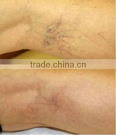 2016 hottest laser hair removal machine 1064nm Laser Hair Removal machine P001