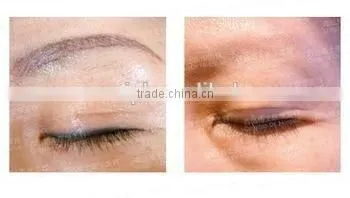 Manufactory Nd yag laser 1064&532nm for tattoo removal and black doll therapy with skin carbon charcola therapy laser deep clean