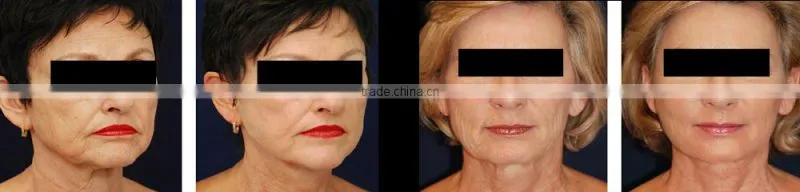 2015 Newest rf fractional micro needle skin tightening machine