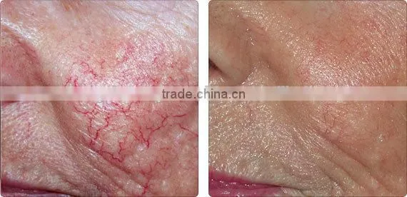 Vein removal high frequency vascular veins removal redness removal