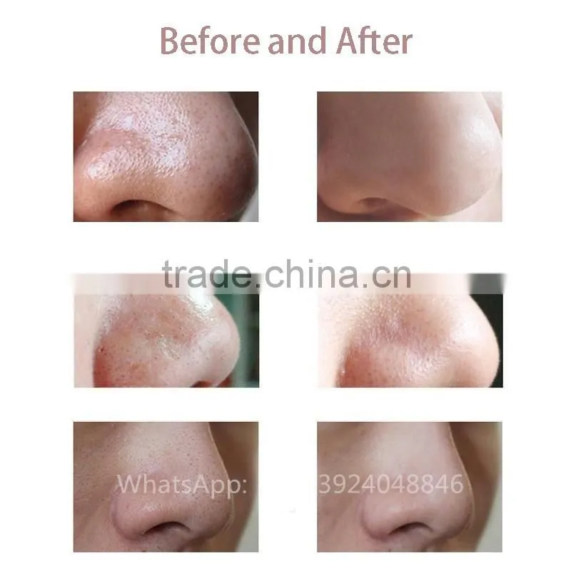 Portable home use micro crystal blackhead removal facial suction beauty vacuum machine blackhead remover tool