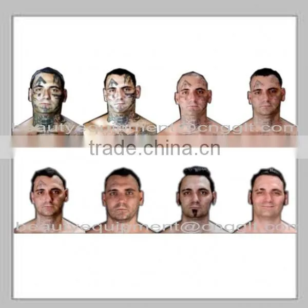 Factory price tattoo removal costs for black , red, brown,colorful tattoo