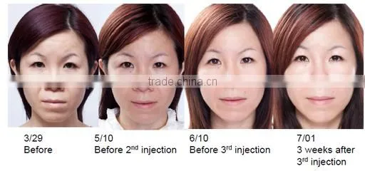Merry christmas present !portable hifu rf wrinkle removal skin tightening machine for home use