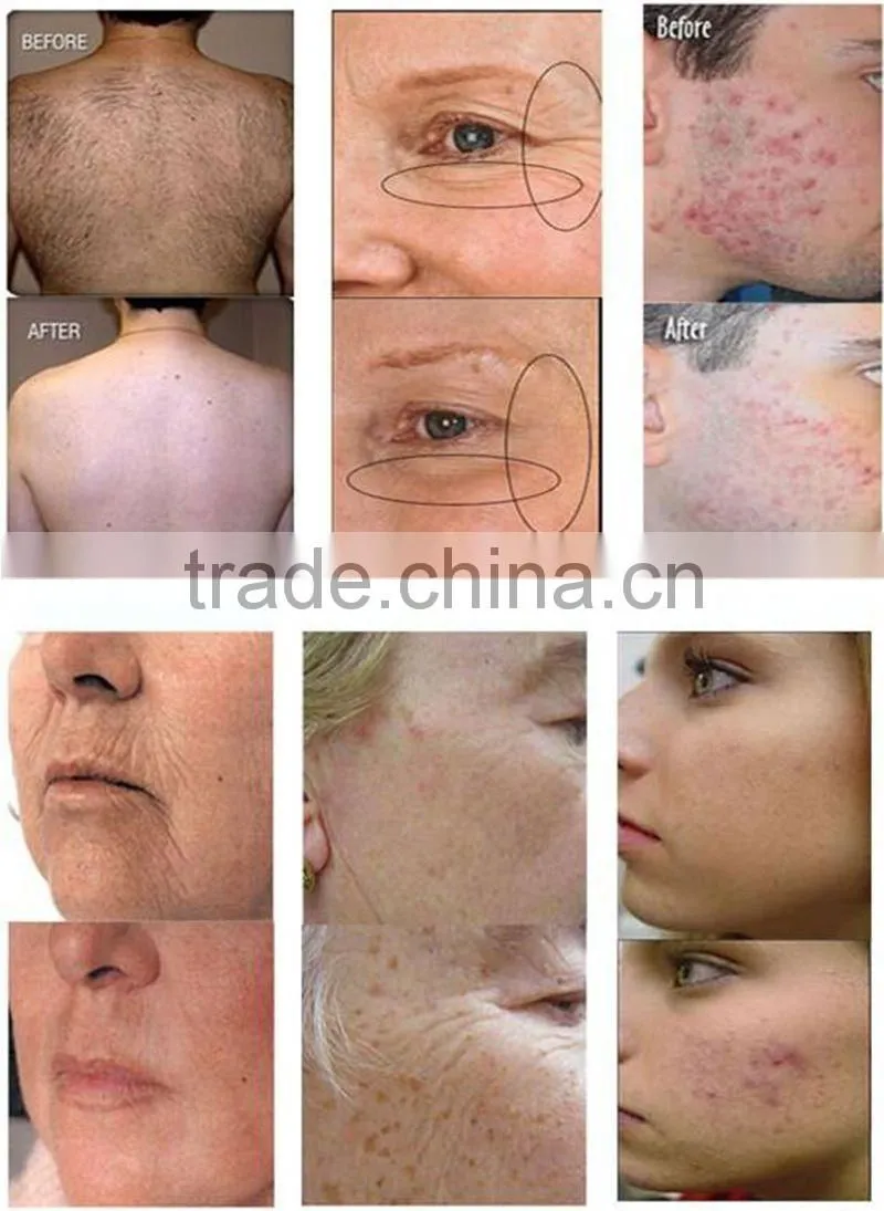 2015 multifunctional hair removal machine shr elight ipl light hair remove